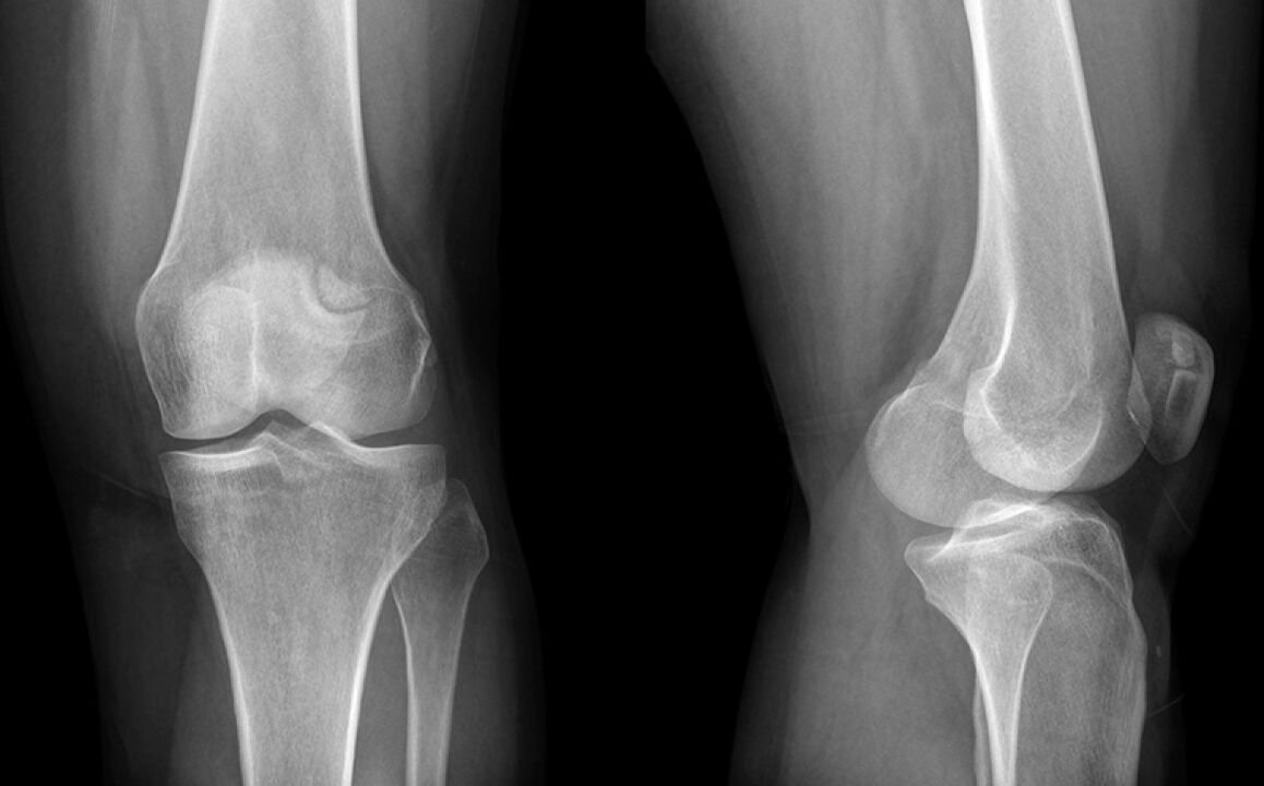 Die Arthrose des Knies am Radius X vor der Verwendung der Umlaufbahn