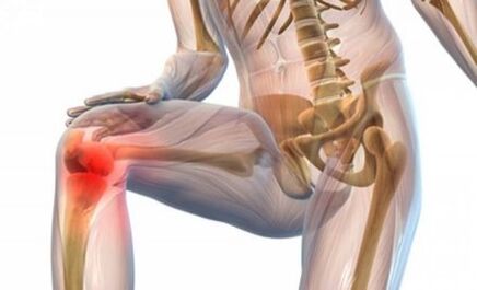 Arthrose des Kniegelenks