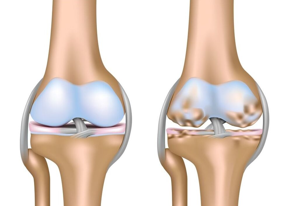 Arthrose des Kniegelenks